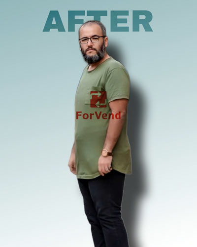 بعد از جراحی چاقی 2