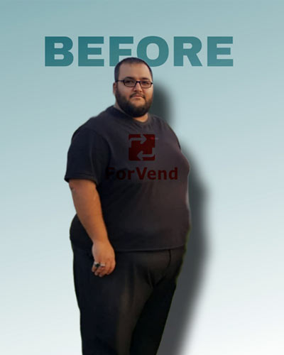 قبل از جراحی چاقی 2